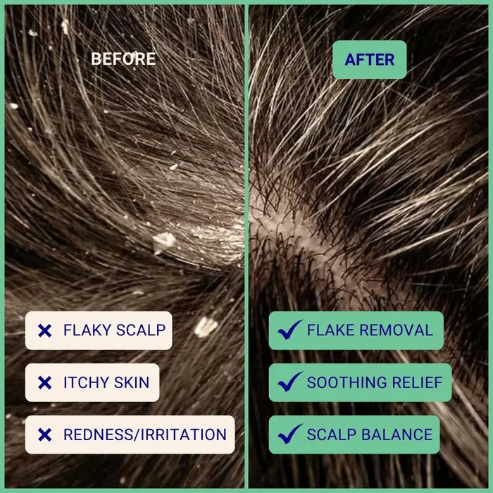 1 Year Supply (320x Washes ) - Exfoliating Shampoo For Loose Dandruff Flakes Tea Tree & Salicylic Acid