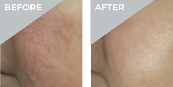 3D Vasculase Treatment