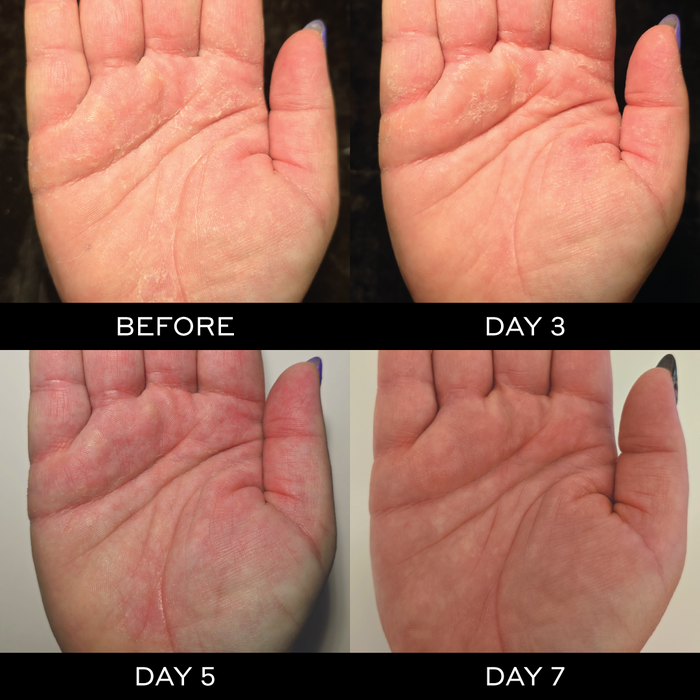 creme de la zen hydrating cream before and after hand shot from 7 days of use