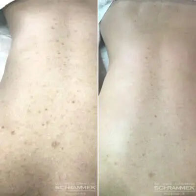 The Original GREEN PEEL® herbal peeling